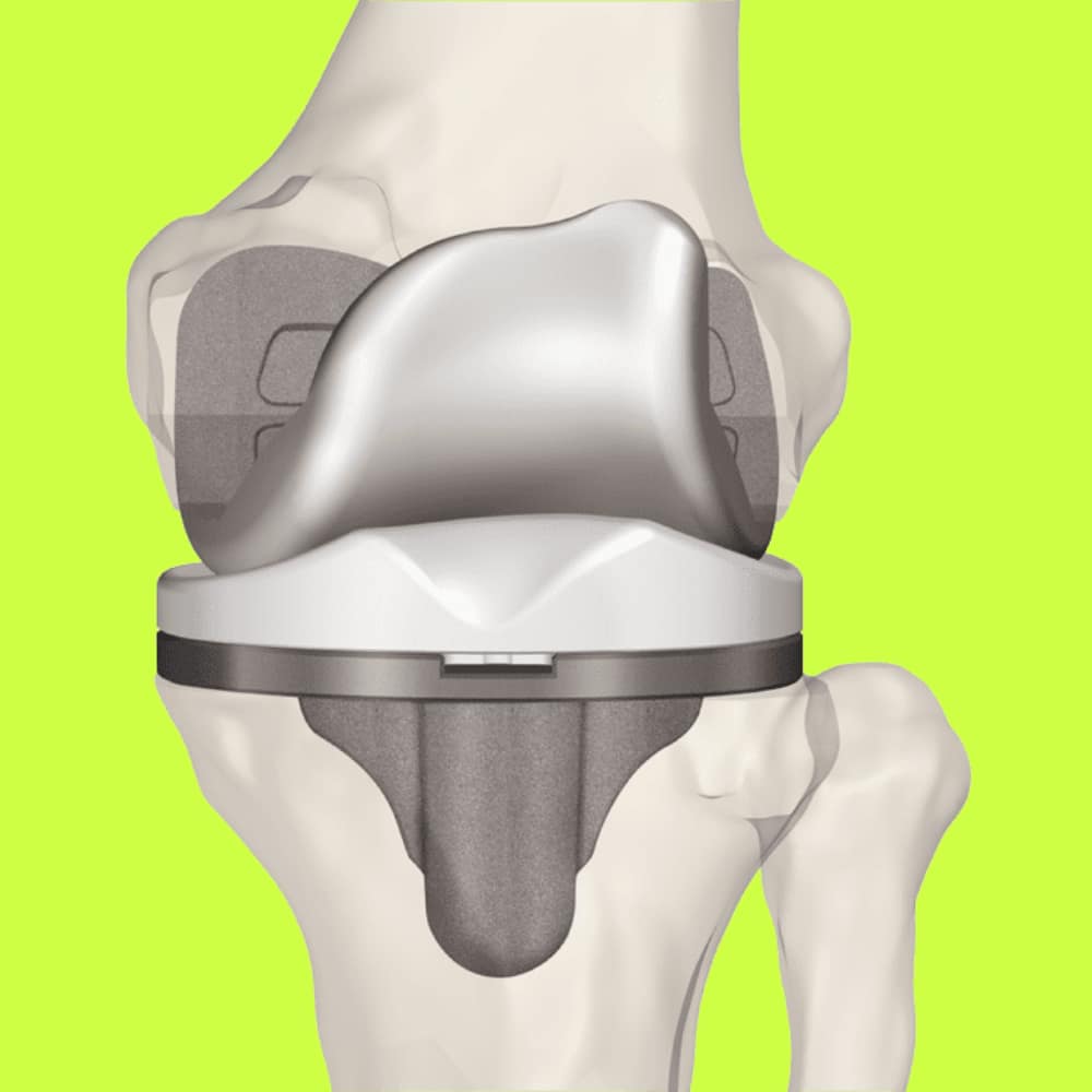 Knee replacement Perth